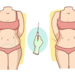 اسعار عملية التكميم