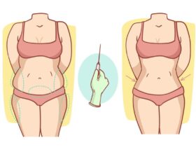 اسعار عملية التكميم