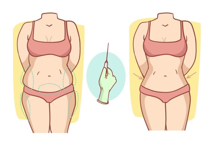 اسعار عملية التكميم