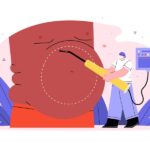 أرخص عملية تكميم في مصر